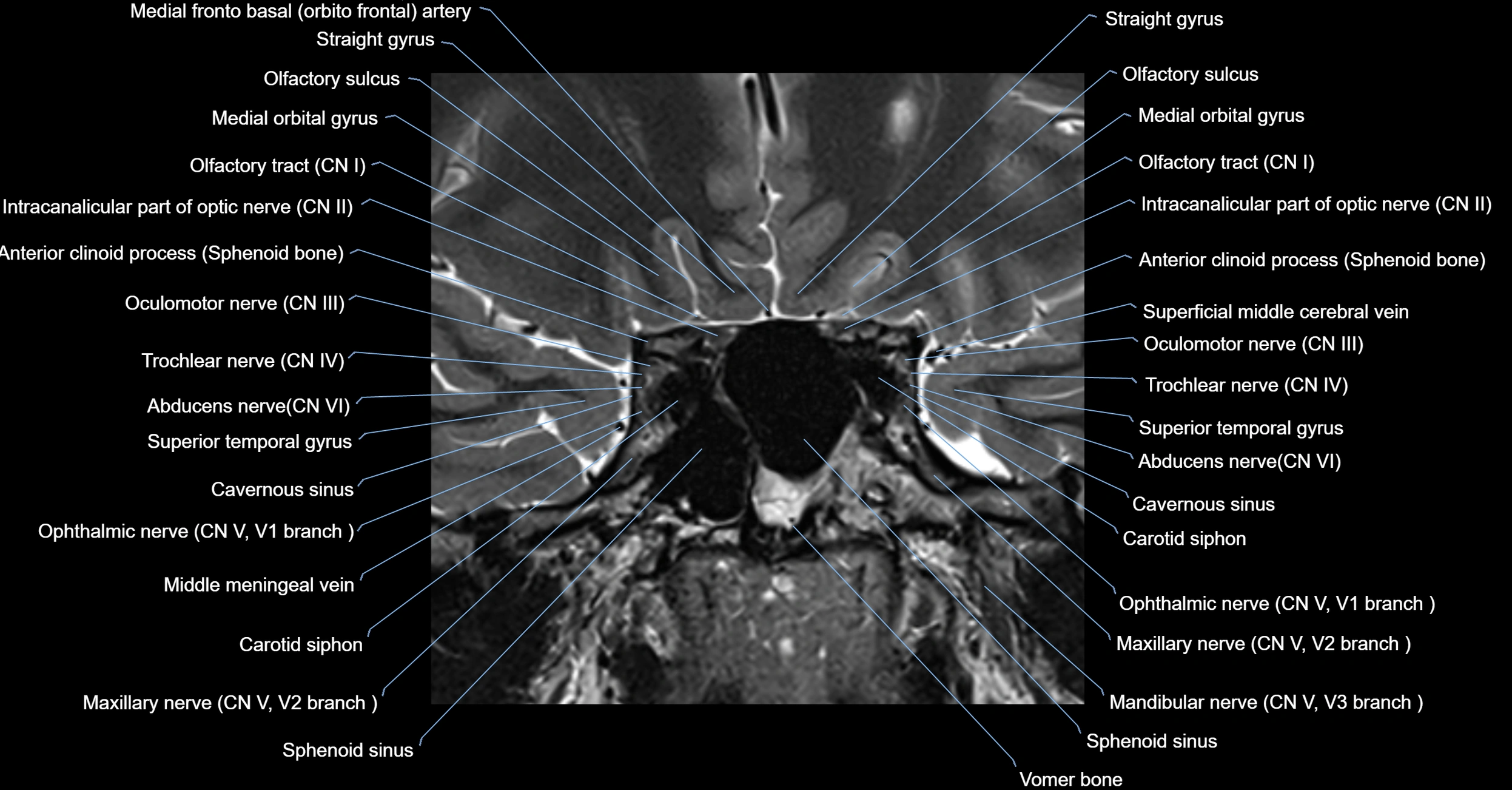 MRI cavernous sinus coronal cross sectional 3T anatomy image-img-00001-00005.webp